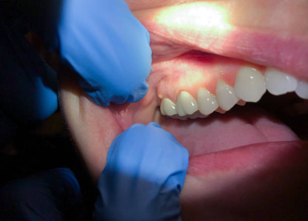 Best Emergency Dental Care for Broken or Chipped Teeth in Cayuga, IN